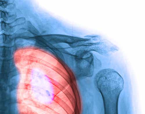 Síntomas del cáncer de pulmón que debes conocer