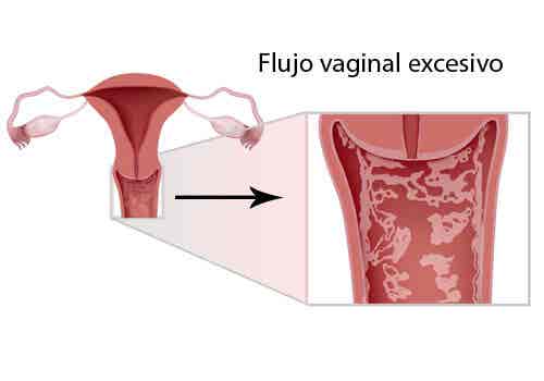 Síntomas, tratamientos y prevención de la vulvovaginitis