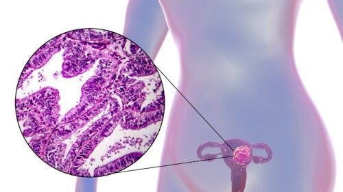 ¿Cómo combatir el cáncer de matriz?