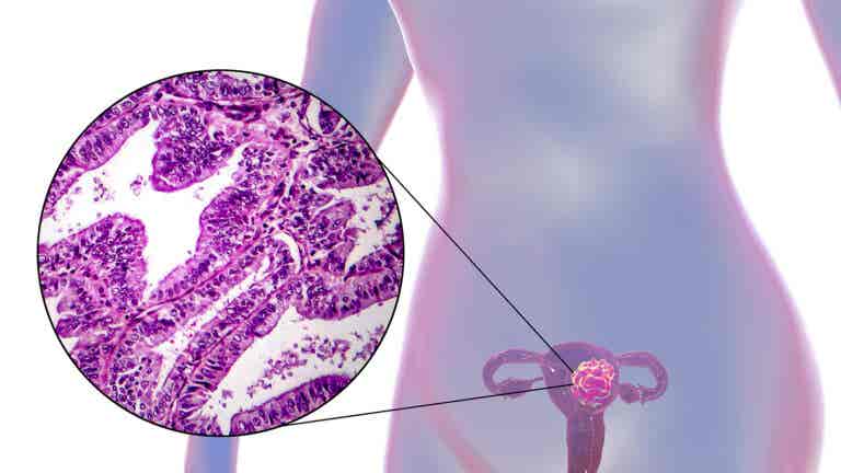 ¿Cómo combatir el cáncer de matriz?