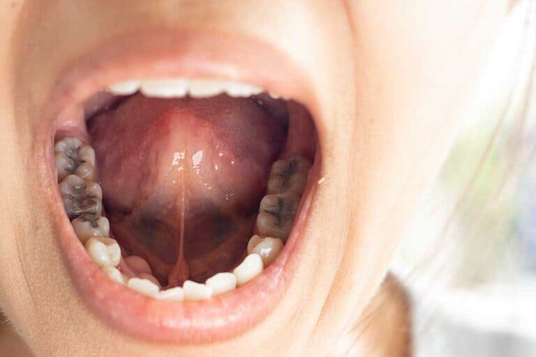 Caries: causas y remedios naturales
