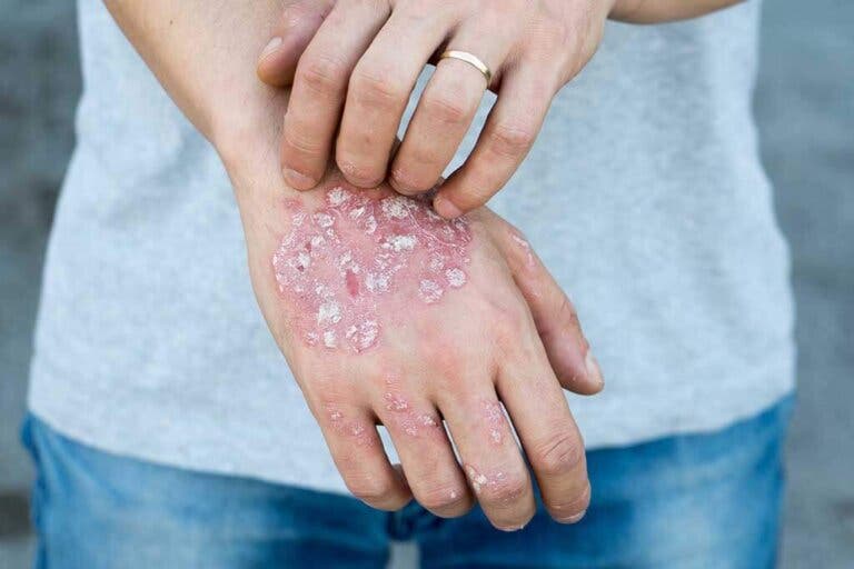 ¿Qué es y cómo tratamos naturalmente la esclerodermia?