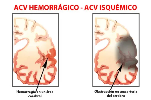 ACV