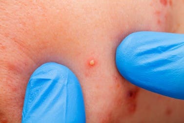 ¿Por qué nos salen granos y cómo prevenirlos?