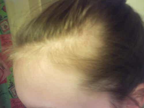Remedio con albahaca para la alopecia