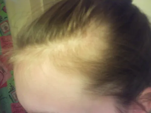 Alopecia o caída del cabello