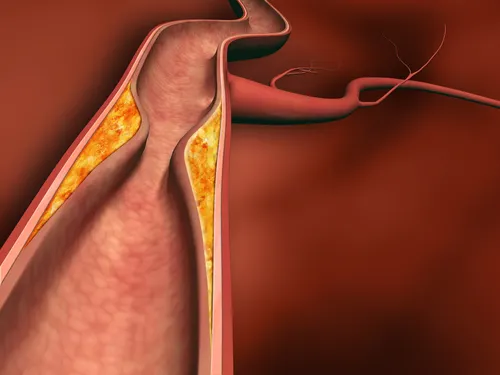 Arteriosclerosis