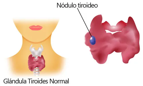 Cómo identificar si un bulto es benigno o maligno