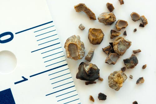 Cómo prevenir los cálculos renales o litiasis renal