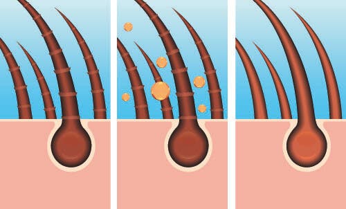 Remedios naturales para el cabello graso