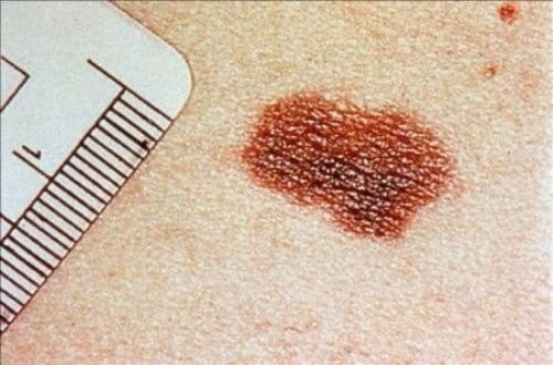 Cancer de piel