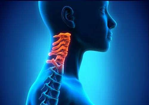 Espondilosis cervical