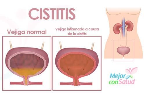 ¿Qué es la cistitis? ¿Cómo tratarla?