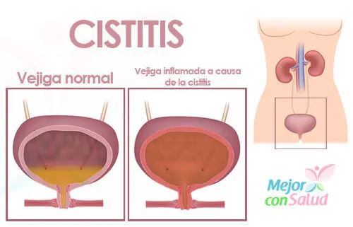 ¿Qué es la cistitis? ¿Cómo tratarla?