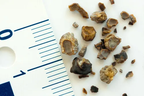 Cómo prevenir los cálculos renales o litiasis renal