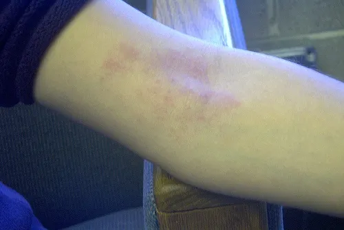 Cómo prevenir la dermatitis