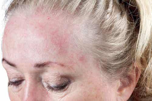 Dormir con el pelo húmedo podría contribuir a generar infecciones cutáneas.