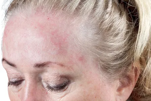 Prevenir la dermatitis