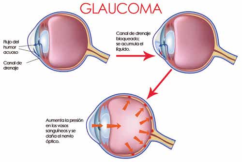 Glaucoma: cundo ocurre y cmo evitarlo