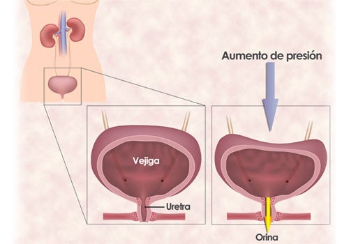 Ejercicios para la incontinencia urinaria de la mujer