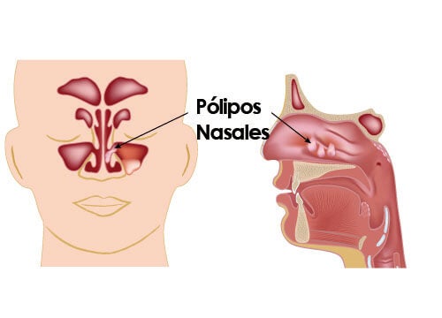 ¿Cómo tratar y prevenir los pólipos nasales?
