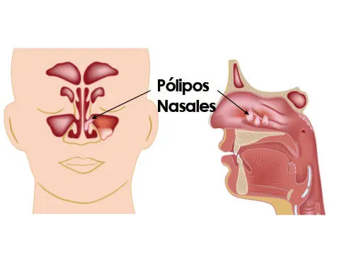 ¿Cómo tratar y prevenir los pólipos nasales?