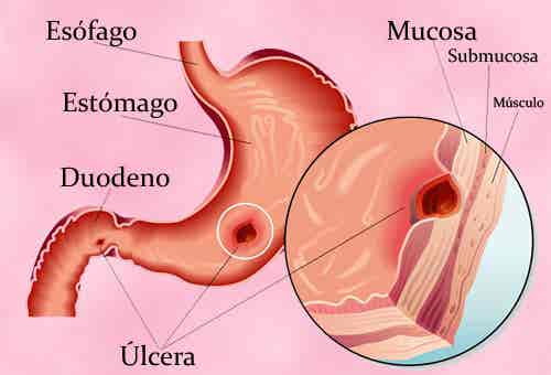 Tratamiento coadyuvante para las úlceras en el estómago