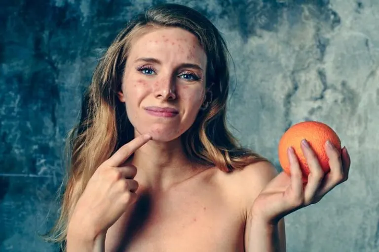 Remedios naturales para las cicatrices del acné