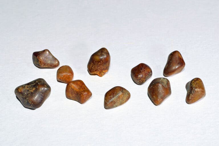 Cómo evitar las piedras en la vesícula biliar