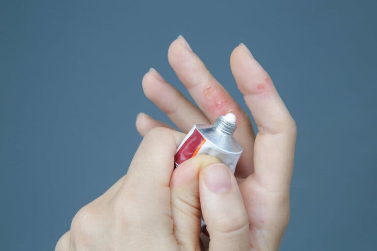Tratamiento para la dermatitis