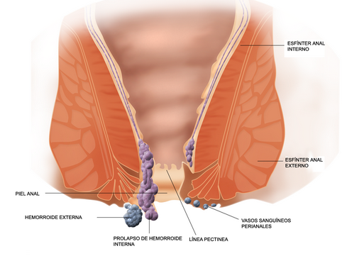 esquema del recto mostrando hemorroides