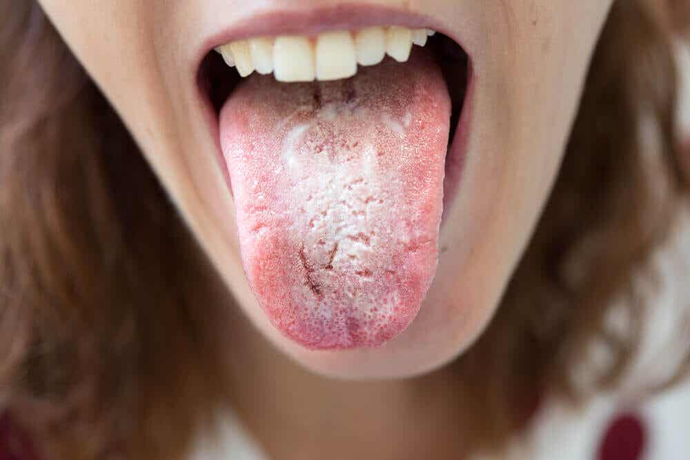 La lengua blanca es uno de los síntomas de la candidiasis oral.