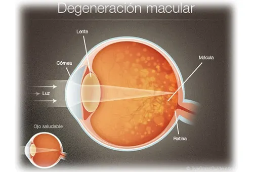Dégénérescence maculaire