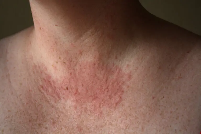 ¿Cómo combatir la alergia al sol?