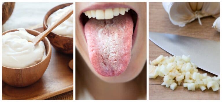 Remedios caseros para tratar la candidiasis oral: una revisión