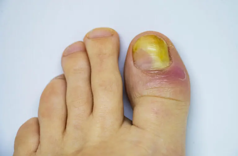 Remedios caseros para hongos en las uñas