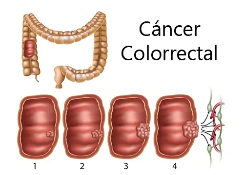 cáncer colorrectal en mujeres