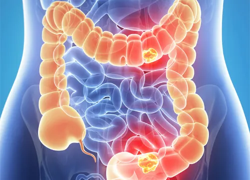 Cancro del colon
