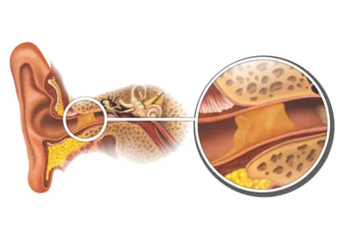 ¿Cómo retirar los tapones de cera de forma natural?