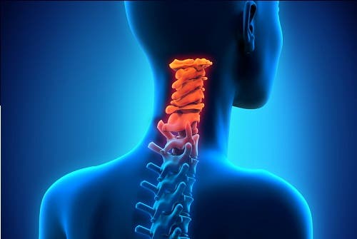 ¿Cómo prevenir la artrosis cervical?