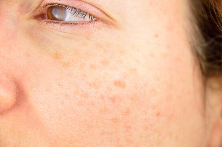 ¿Cómo quitar las manchas en la piel?