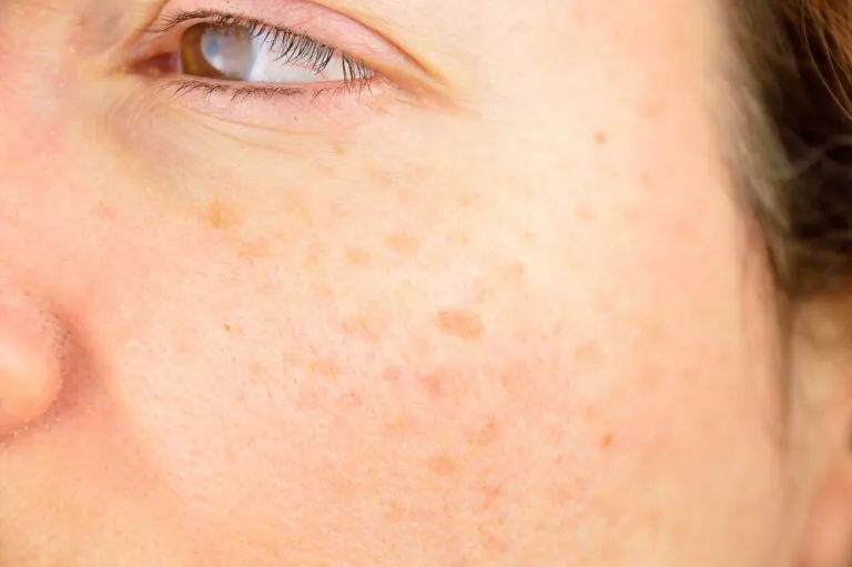 ¿Cómo quitar las manchas en la piel?