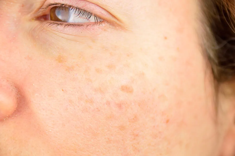 Agua oxigenada como remedio natural para aclarar manchas en la piel