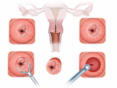 Síntomas y tratamiento del ectropión cervical