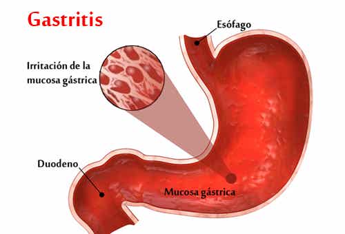 La gastritis, ¿por qué la padecemos?