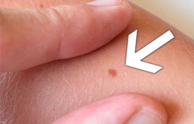 ¿Cómo identificar los lunares peligrosos?