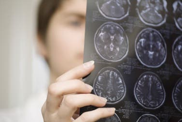 Alimentos y suplementos para prevenir el Parkinson