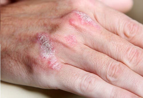 Psoriasis: una dieta para reducir algunos síntomas