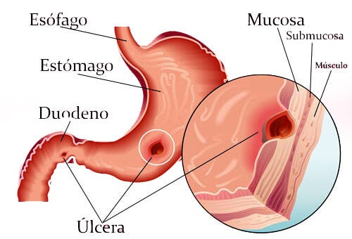 Remedios naturales para las úlceras gástricas