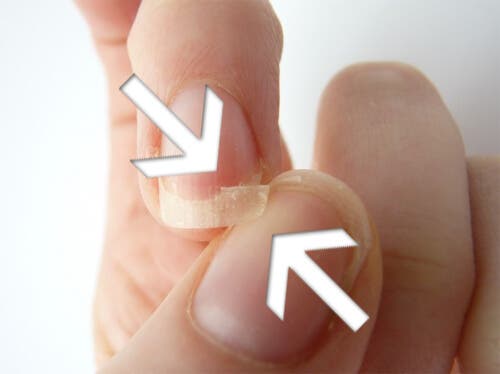 Uñas quebradizas